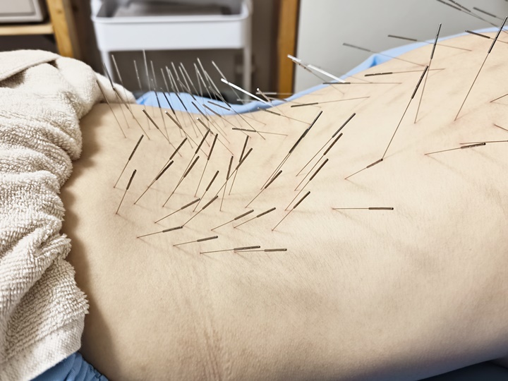 宮崎市で鍼灸による腰痛・坐骨神経痛の根本治療