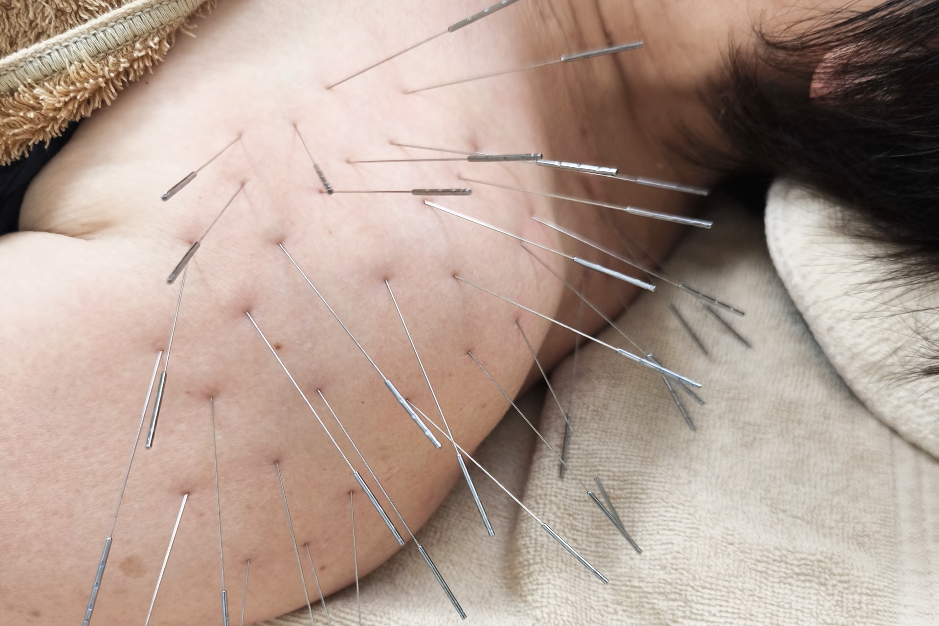 鹿児島市で鍼灸による五十肩・四十肩の実際の治療風景