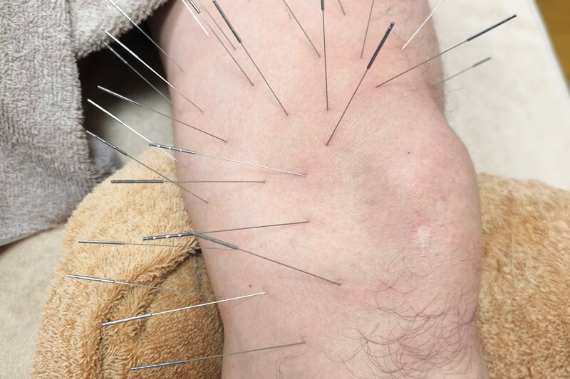 膝痛への施術の様子