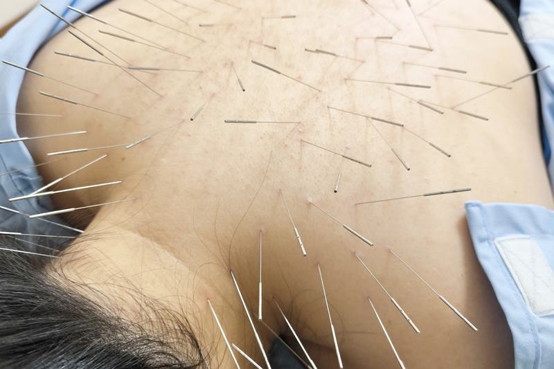 花粉症・アレルギー改善の鍼灸施術