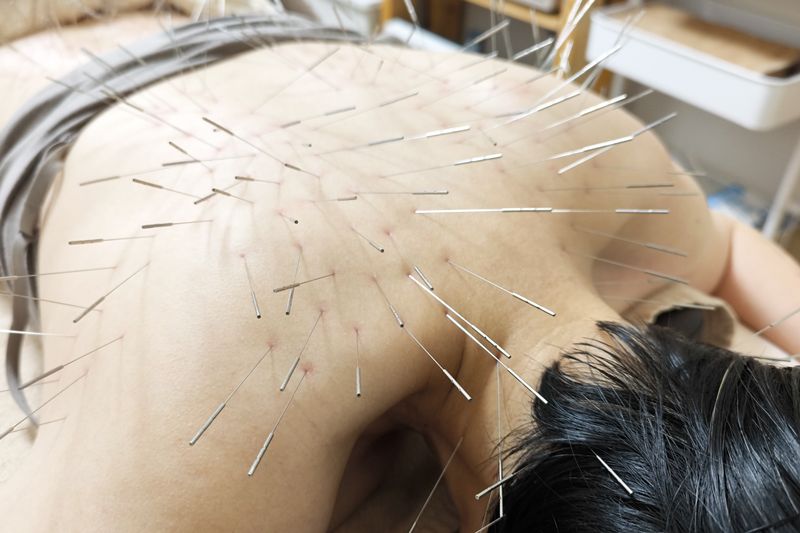 ルート治療の施術風景