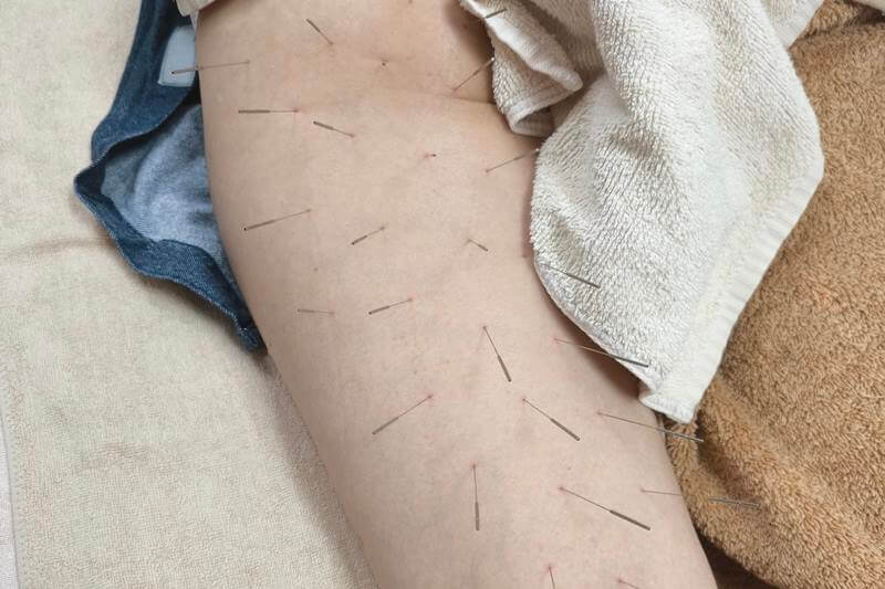 お尻から足にかけての鍼治療
