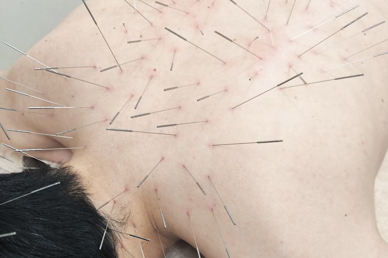 うつ病・自律神経失調症の鍼治療