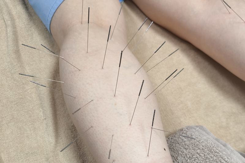 鹿児島市ぎっくり腰鍼灸治療の実際の施術風景（ふくらはぎ）