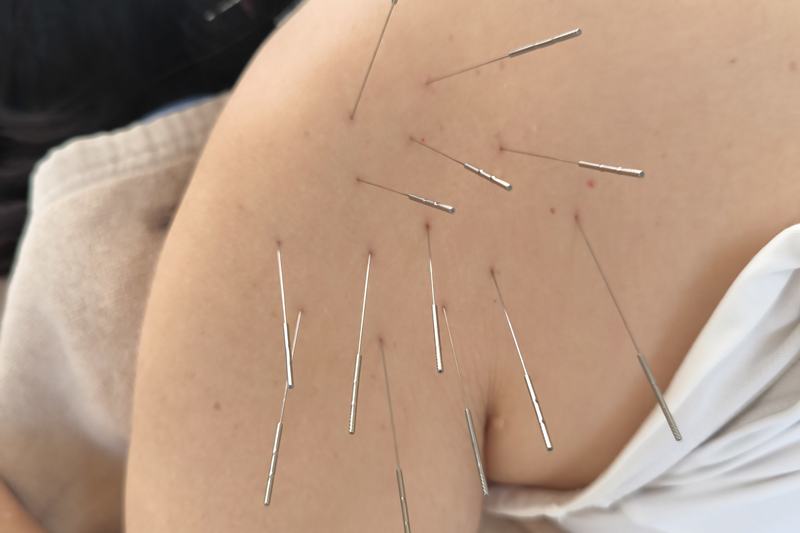 五十肩への施術の様子