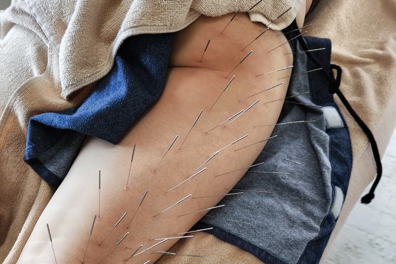 坐骨神経痛改善の鍼灸施術（大腿部）