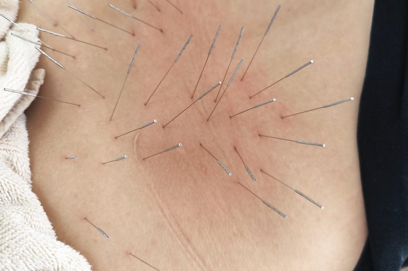 坐骨神経痛改善の鍼灸施術（腰部）