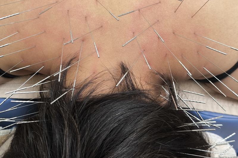 首肩への鍼灸施術