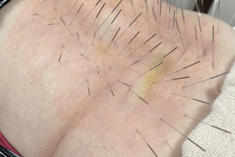 80代女性への腰部鍼灸施術