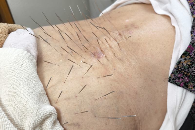 90代女性への腰の鍼治療の様子