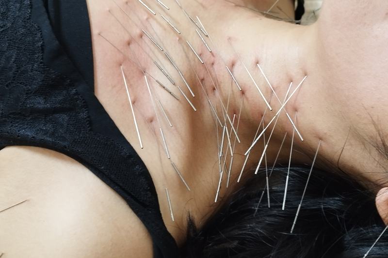 首から胸元への鍼治療