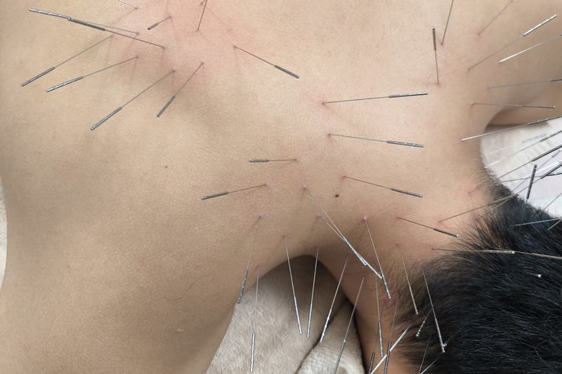 ぎっくり首（寝違い）への施術の様子