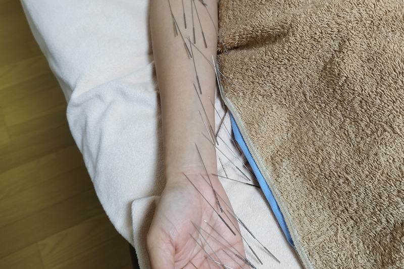 手の平から前腕内側部への鍼治療