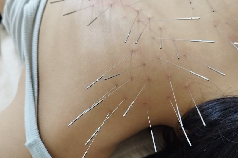 首肩への鍼治療