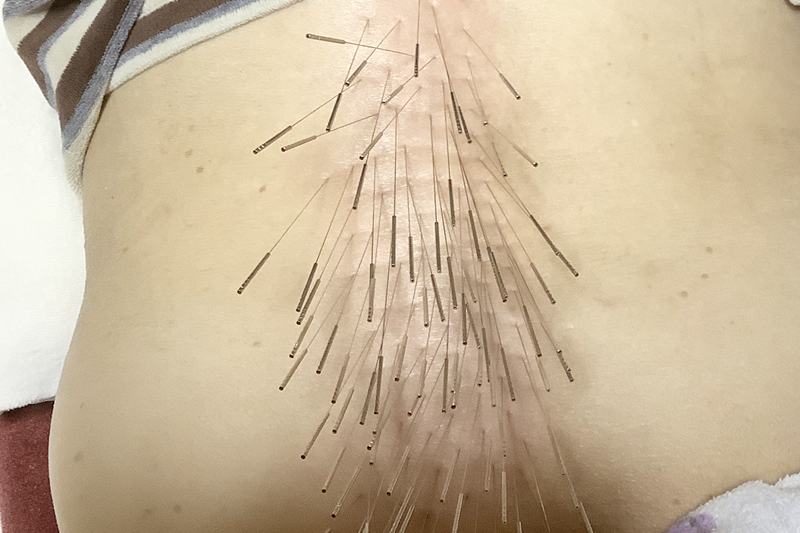 脊柱管狭窄症への鍼灸施術