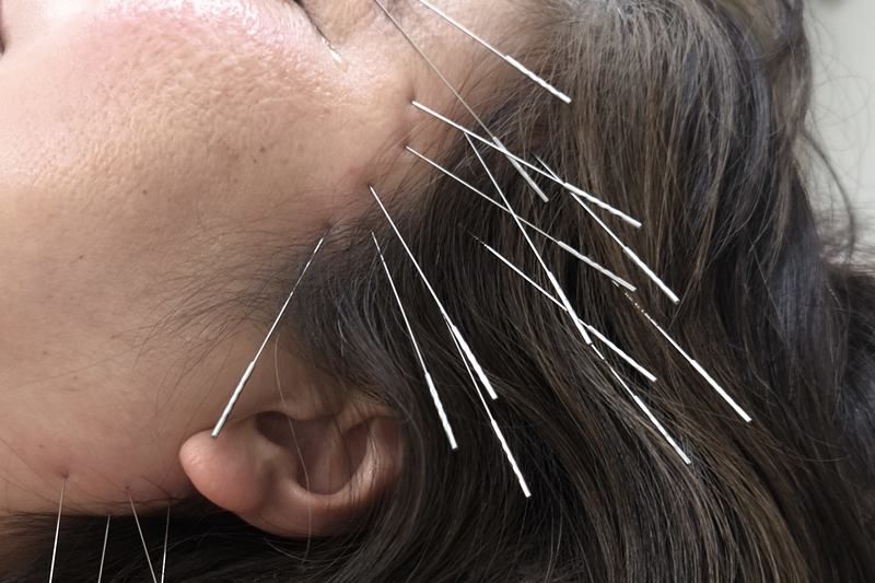 鹿児島市で鍼灸による頭痛の根本治療