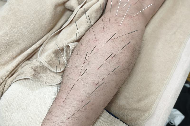 下腿部への鍼灸施術