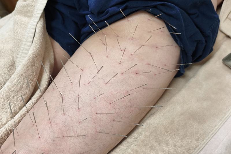 大腿部後面への鍼灸施術