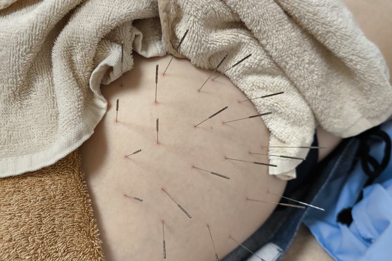 右臀部への施術