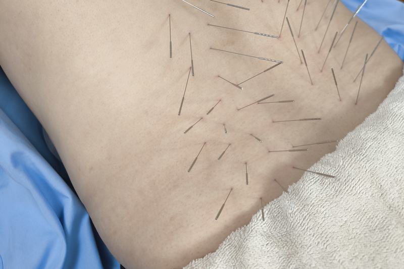 鹿児島市で鍼灸によるぎっくり腰の治療