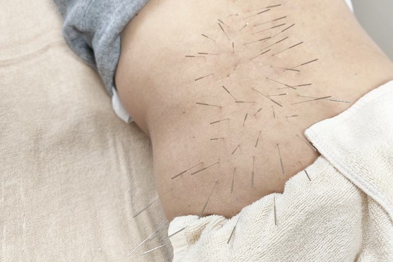 鹿児島市 坐骨神経痛 鍼灸による根本治療