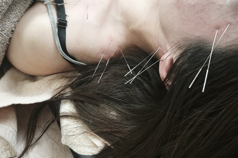 鹿児島市できやま鍼灸治療院の首肩こり頭痛の施術
