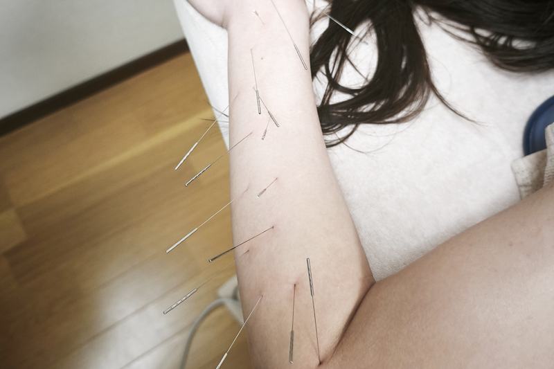 手根管症候群の疑いで左前腕への鍼灸施術