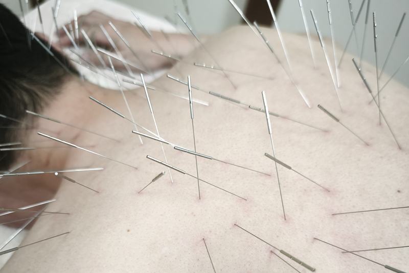 鹿児島市で治らない肩こりへの鍼灸治療