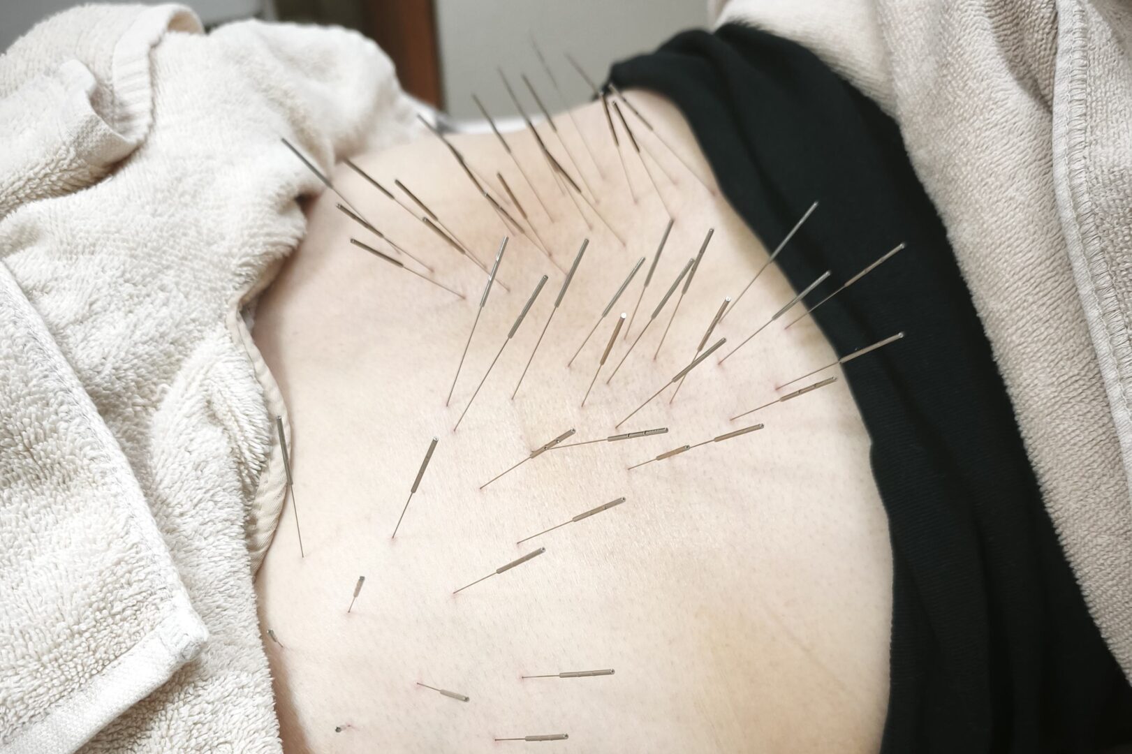 鹿児島市で坐骨神経痛改善のための鍼灸治療