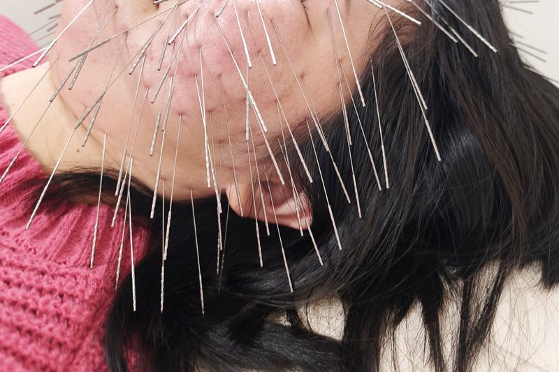 鹿児島市できやま鍼灸治療院の美容鍼施術