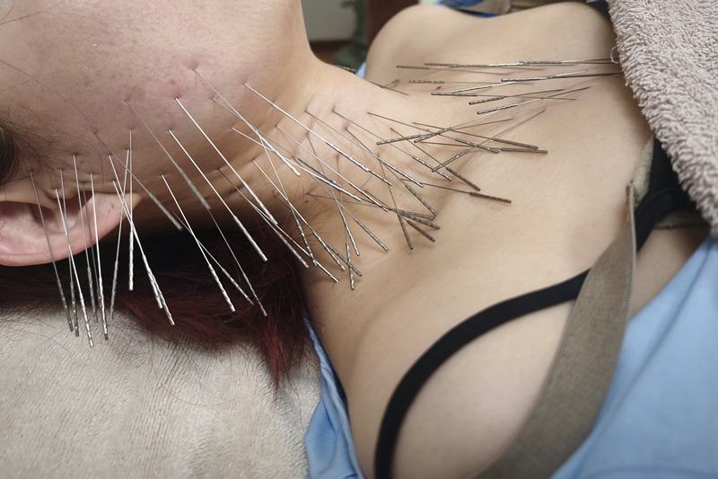 鹿児島市で耳が聞こえにくい症状への鍼治療