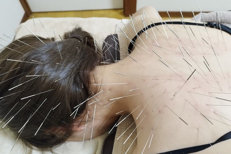 年度末ストレスによる首肩のコリへの鍼灸施術