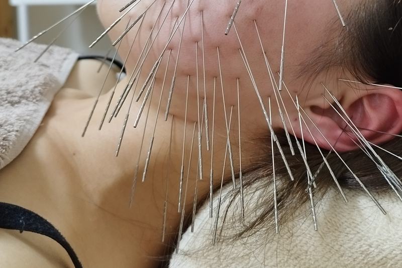 自律神経を整える顔と耳への鍼灸施術