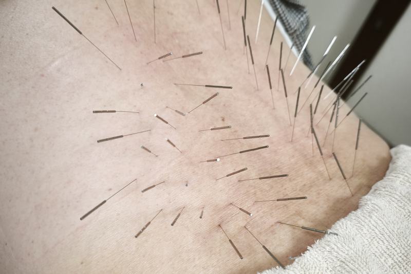 70代男性の慢性腰痛への鍼灸施術