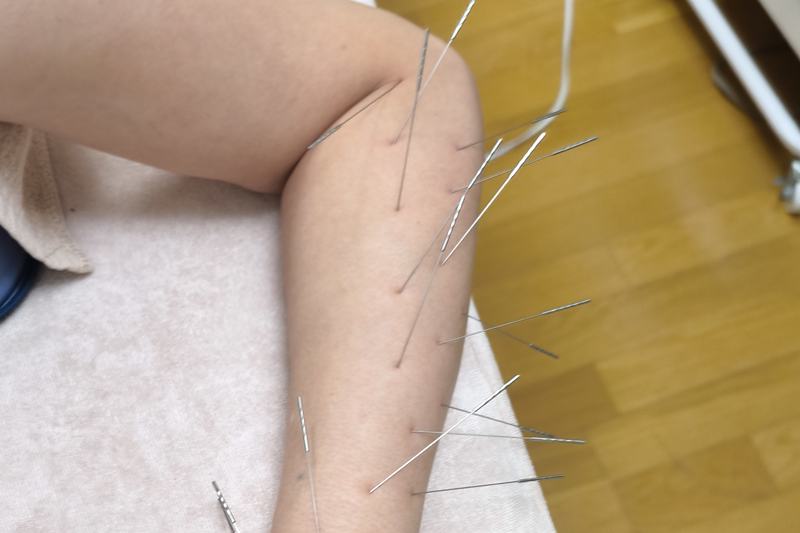 鹿児島市 腱鞘炎 鍼灸|前腕への施術