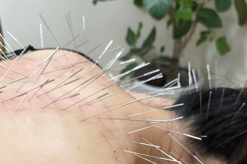 鹿児島市 腱鞘炎 鍼灸|首・肩への施術