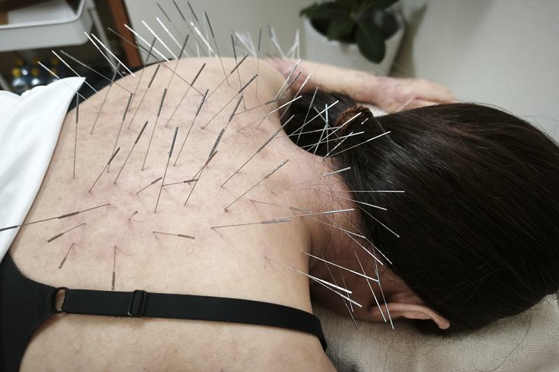 鹿児島市 全身の凝り 鍼灸｜首・肩への施術