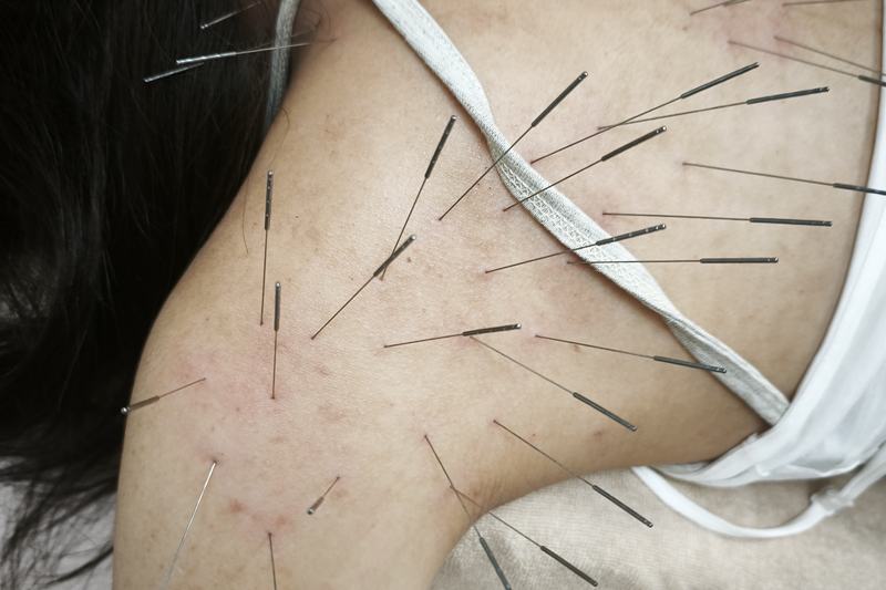 鹿児島市 全身の凝り 鍼灸｜肩から上腕への施術