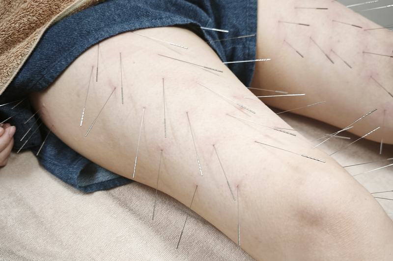 鹿児島市 全身の凝り 鍼灸｜大腿部への施術