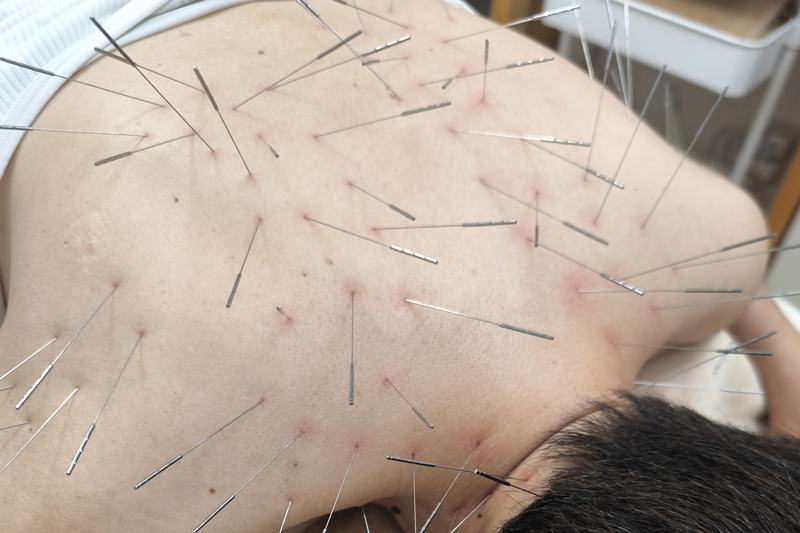 鹿児島市 坐骨神経痛 鍼灸|首・肩への施術