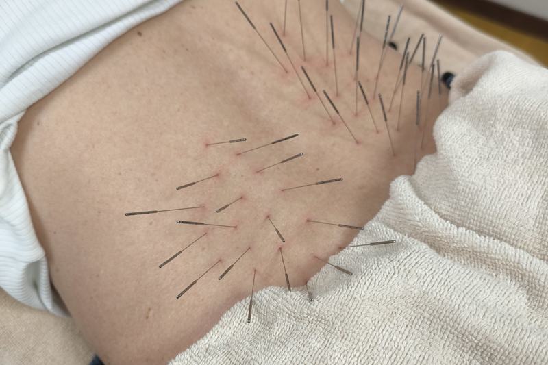 鹿児島市 坐骨神経痛 鍼灸|腰部への施術
