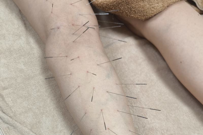 鹿児島市 坐骨神経痛 鍼灸|膝裏からふくらはぎへの施術