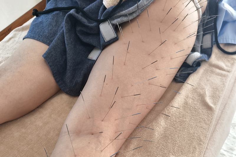 坐骨神経痛への鍼灸施術