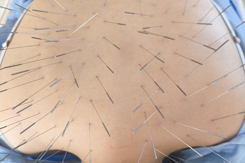 肩・背中への鍼灸施術