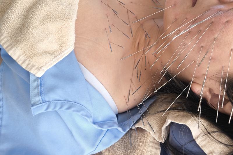 顔・大胸筋部への鍼灸施術