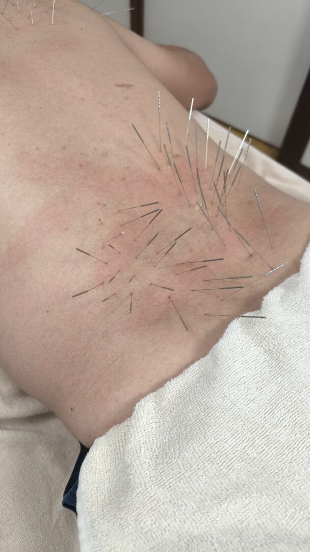 屋久島 腰痛 鍼灸｜腰部への施術