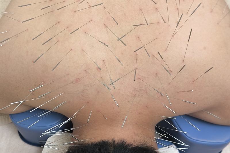 屋久島 腰痛 鍼灸｜首・肩への施術