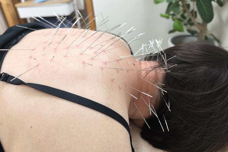 鹿児島市 頭痛・首肩こりへの鍼灸施術
