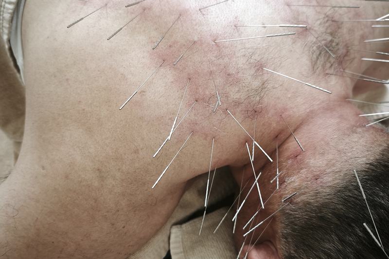 鹿児島市 眼精疲労 頭痛 鍼灸｜首・肩への施術（別角度）｜きやま鍼灸治療院