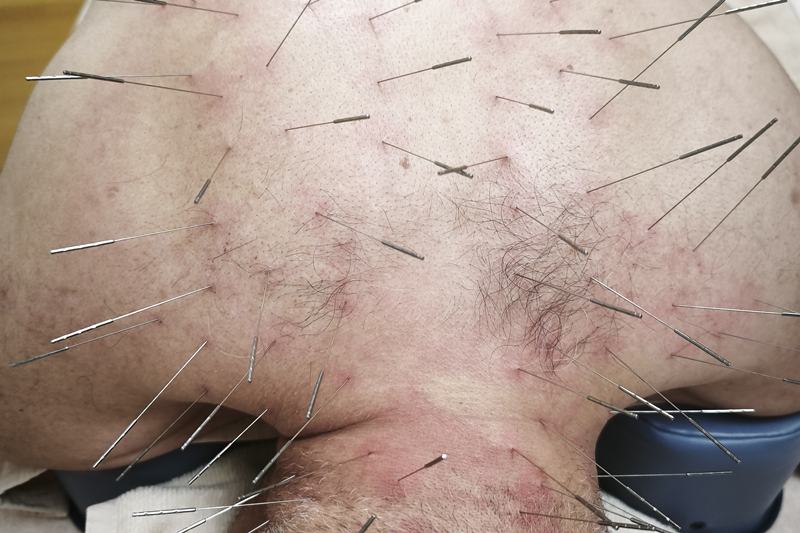 鹿児島市 眼精疲労 頭痛 鍼灸｜首・肩へのルート治療｜きやま鍼灸治療院